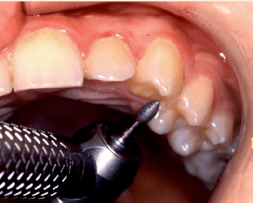 Formation Module 2 - Ajustement occlusal