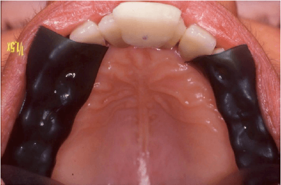 Formation Module 2 - Plaque occlusale